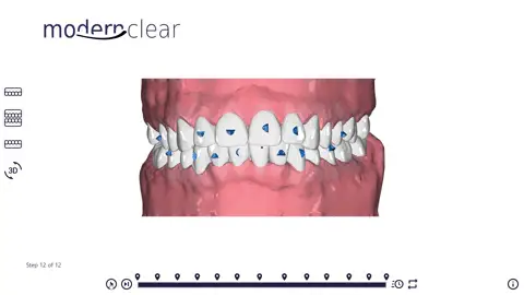 3D simulation of tooth movement with Modern Clear
