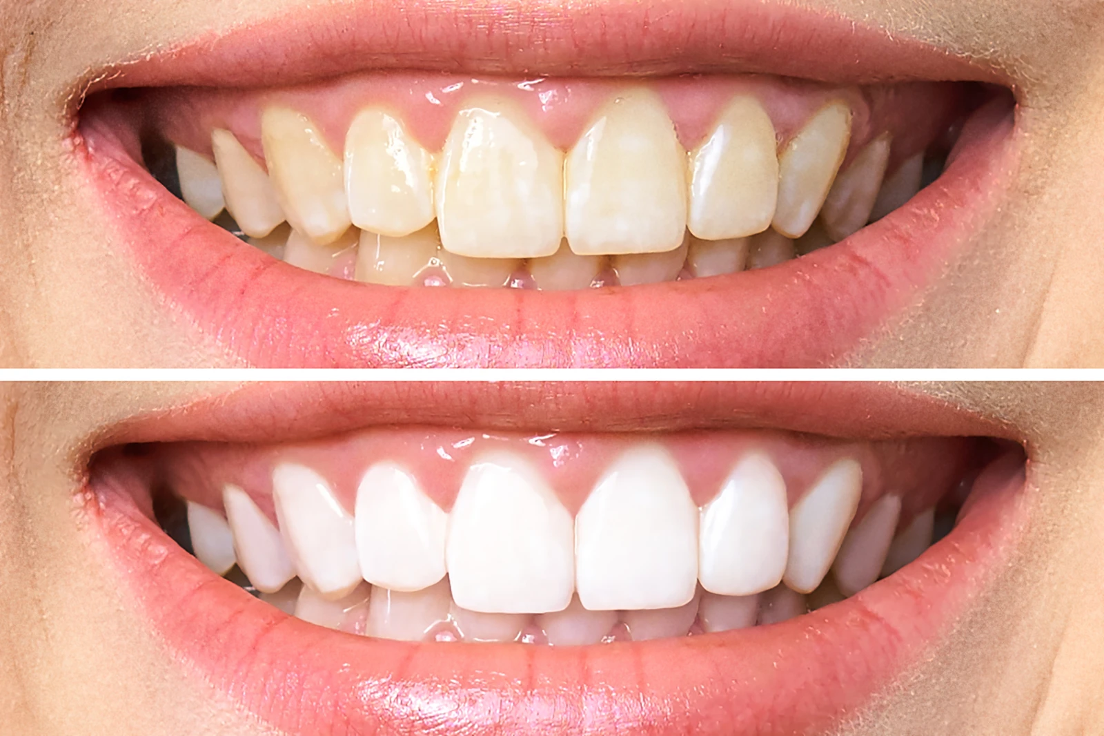 The same teeth before and after professional whitening: yellowish teeth above, noticeably lighter teeth below