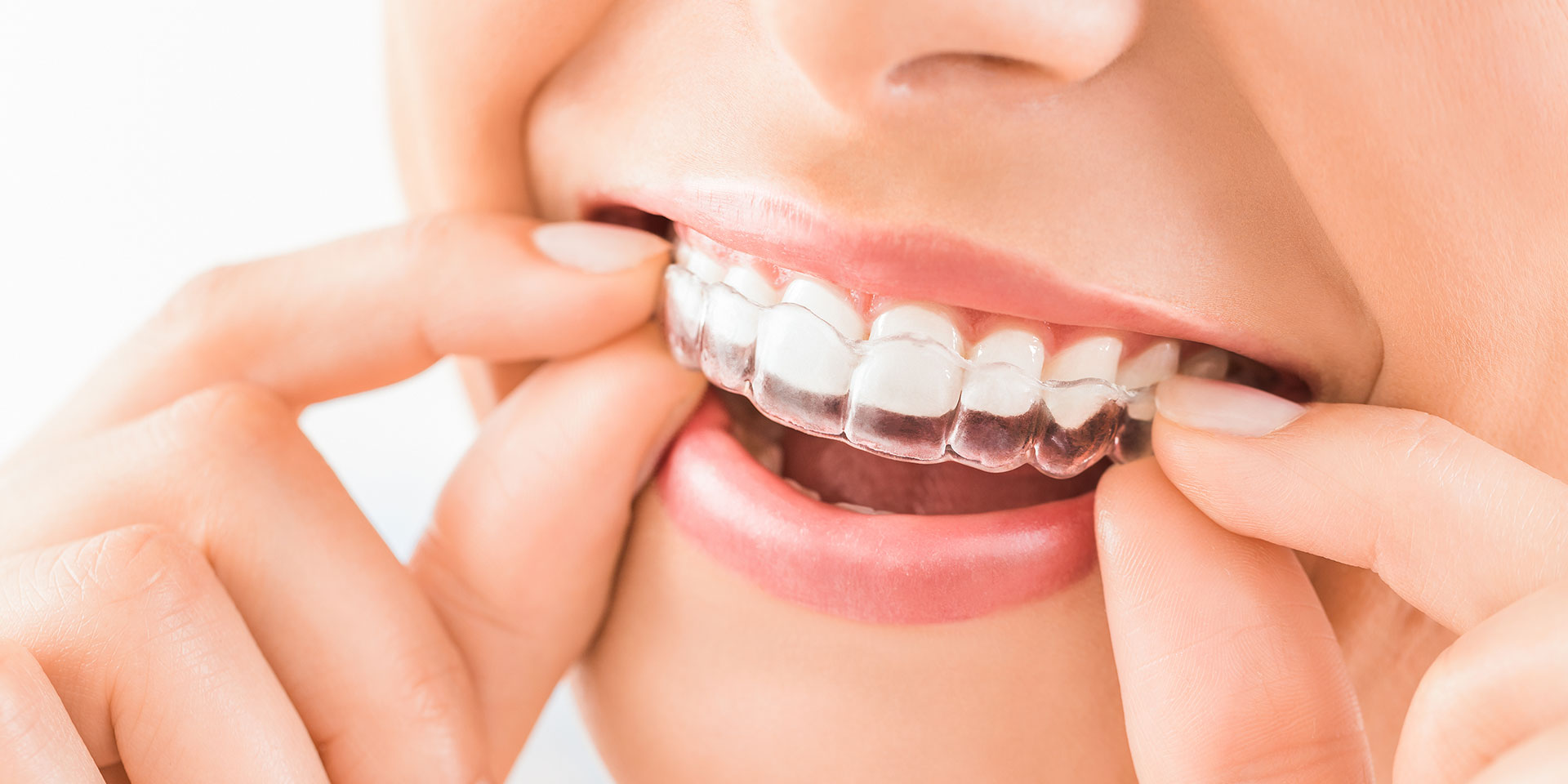 Bite splint against teeth grinding
