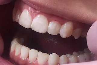 Case study 1: tooth position after treatment