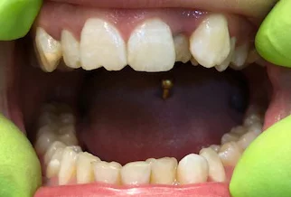 Case study 1: tooth position before treatment