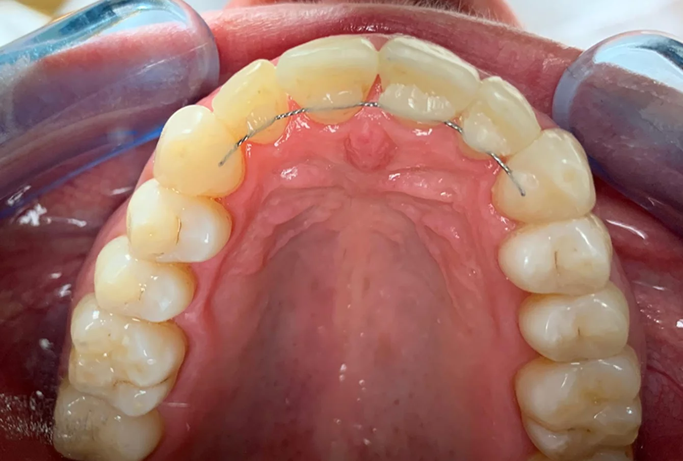 Case study 2: tooth position after treatment