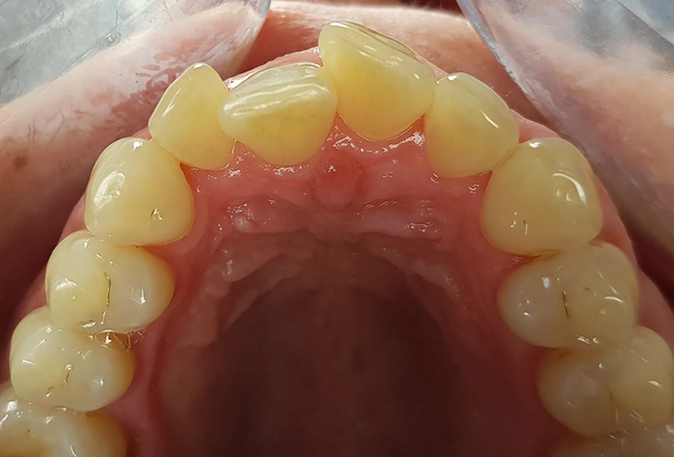 Case study 2: tooth position before treatment
