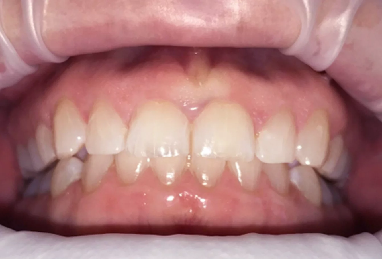 Case study 3: tooth position after treatment