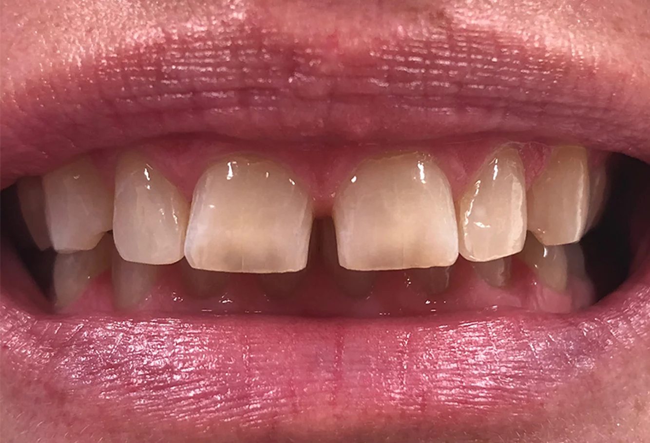Case study 3: tooth position before treatment
