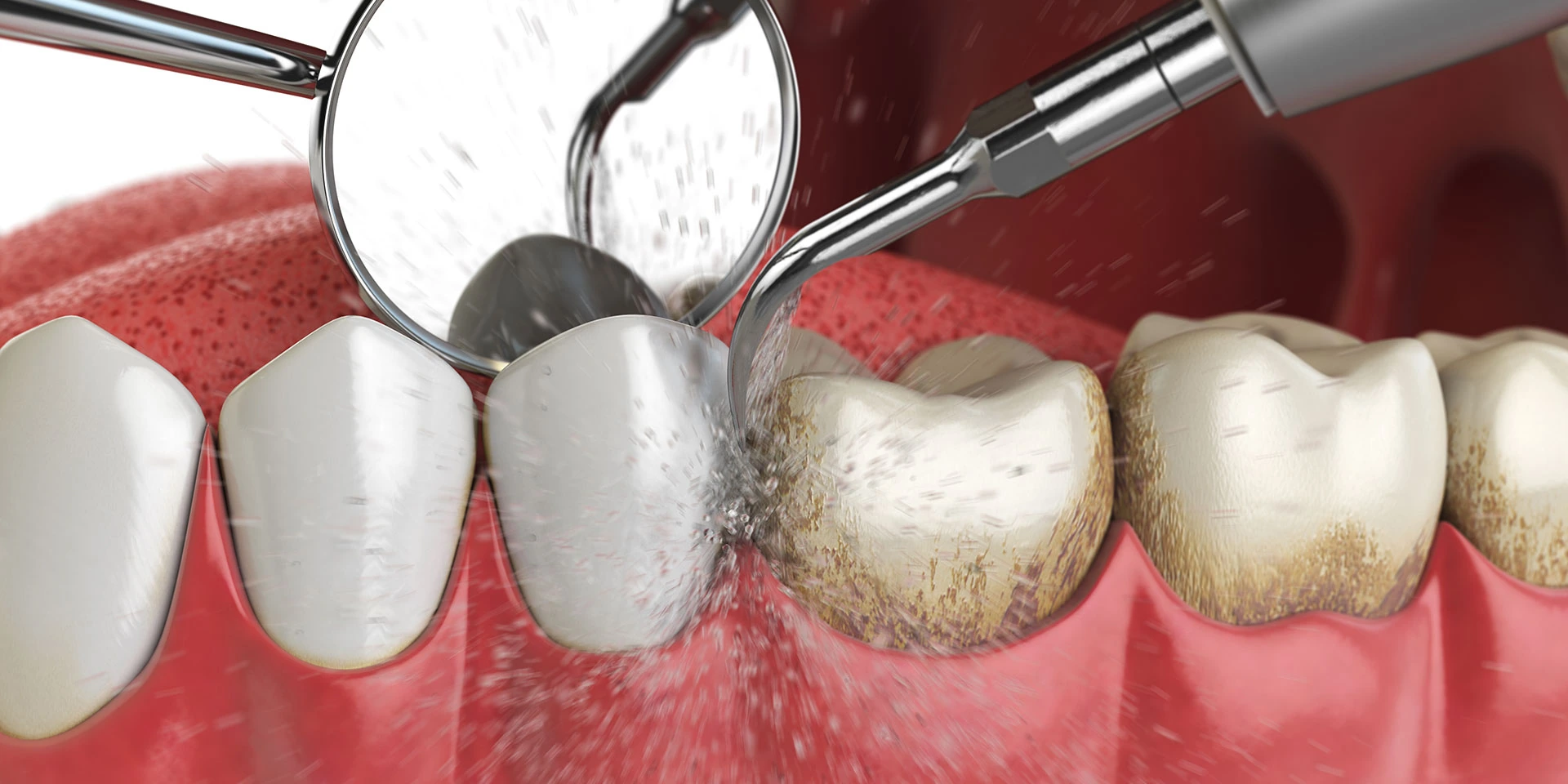 Professional teeth cleaning at the Rita Goutkin practice in Cologne