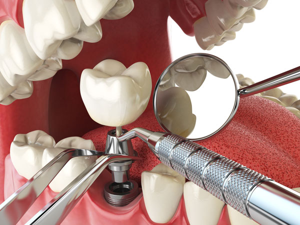 Model of a dental implant of the kind placed in Cologne