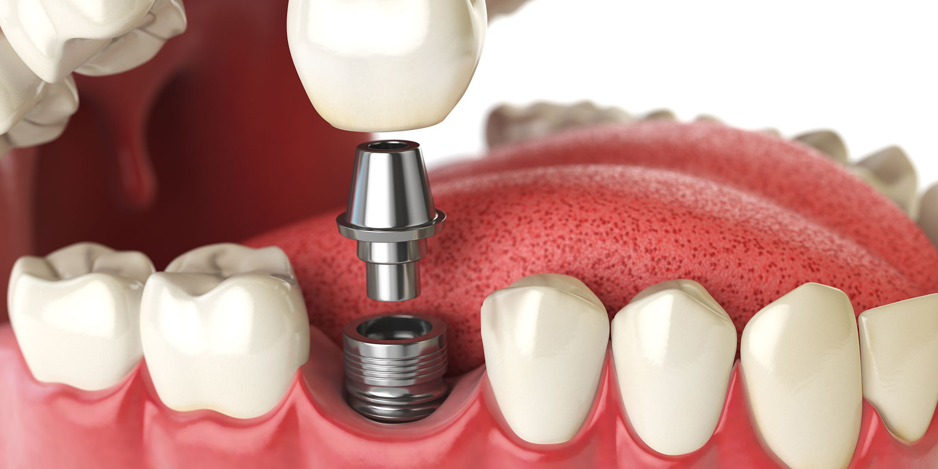 Model of a dental implant