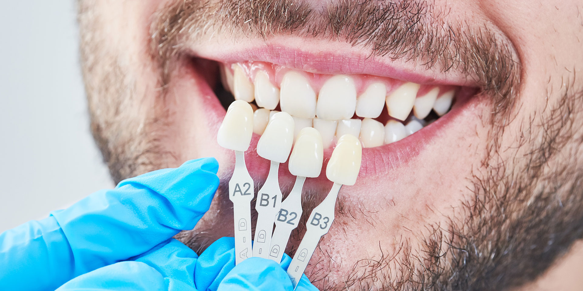 Radiant smile after aesthetic dental treatment in Cologne