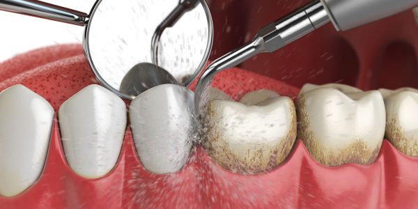 Professional teeth cleaning